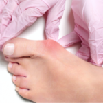 Root Cause Treatment of Bunions with Lapiplasty® 3D Correction™