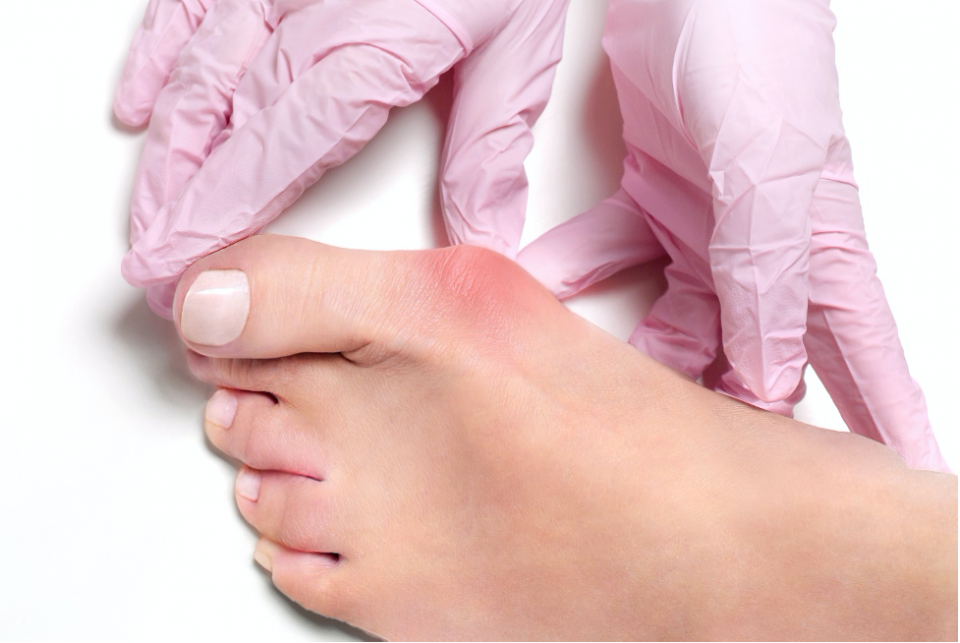 Root Cause Treatment of Bunions with Lapiplasty® 3D Correction™