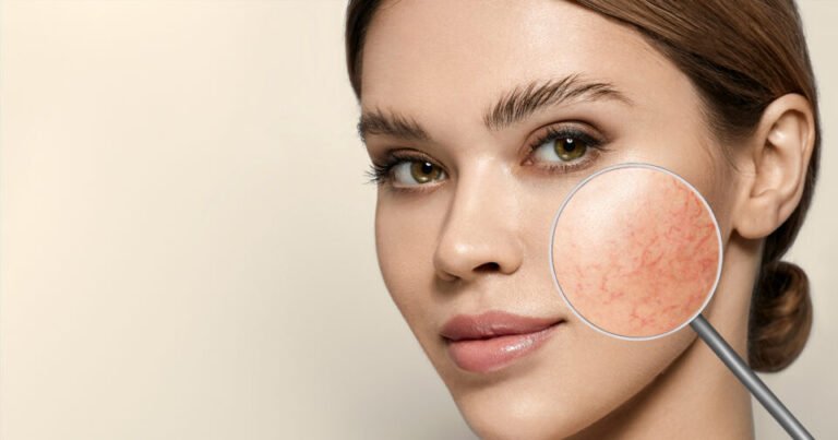 Essential Skin Care for Rosacea Management - Good Life Family Magazine